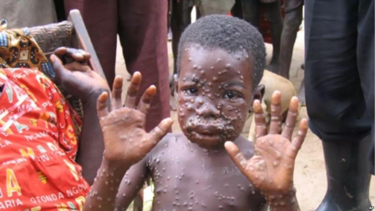 Monkeypox is spreading in Europe, Government of India took a big decision
